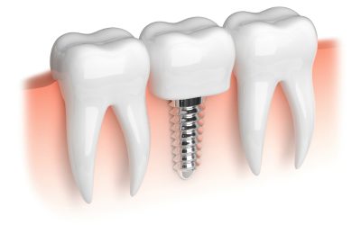 Restore Your Smile at a Dental Implants Clinic Daytona Beach FL Residents Trust
