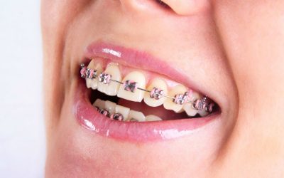 Straighten Your Teeth Faster Using Orthodontist Treatment Greensboro NC Solutions