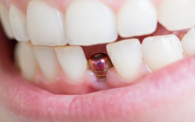 Five Ways Dental Implants Glendale NY Can Improve Your Quality of Life and Confidence