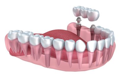 The Lasting Benefits of Choosing Dental Implants in North Edmonton for Tooth Replacement