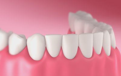 Restoring Your Smile with Dental Crowns Baton Rouge LA Residents Trust for Durability